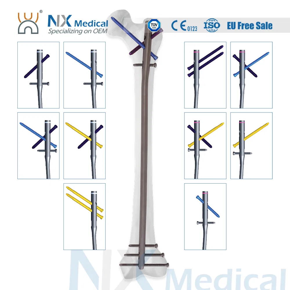 Nx Medical Interlocking Intramedullary Femoral Nail Titanium Orthopedic Implants