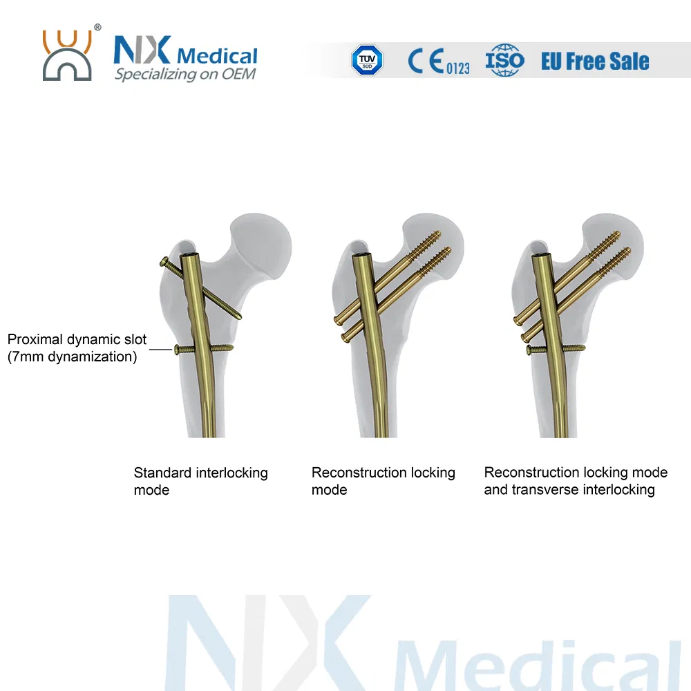 Nx Medical Interlocking Intramedullary Femoral Nail Titanium Orthopedic Implants