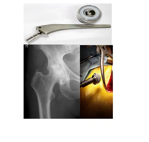Titanium Orthopaedic Implant