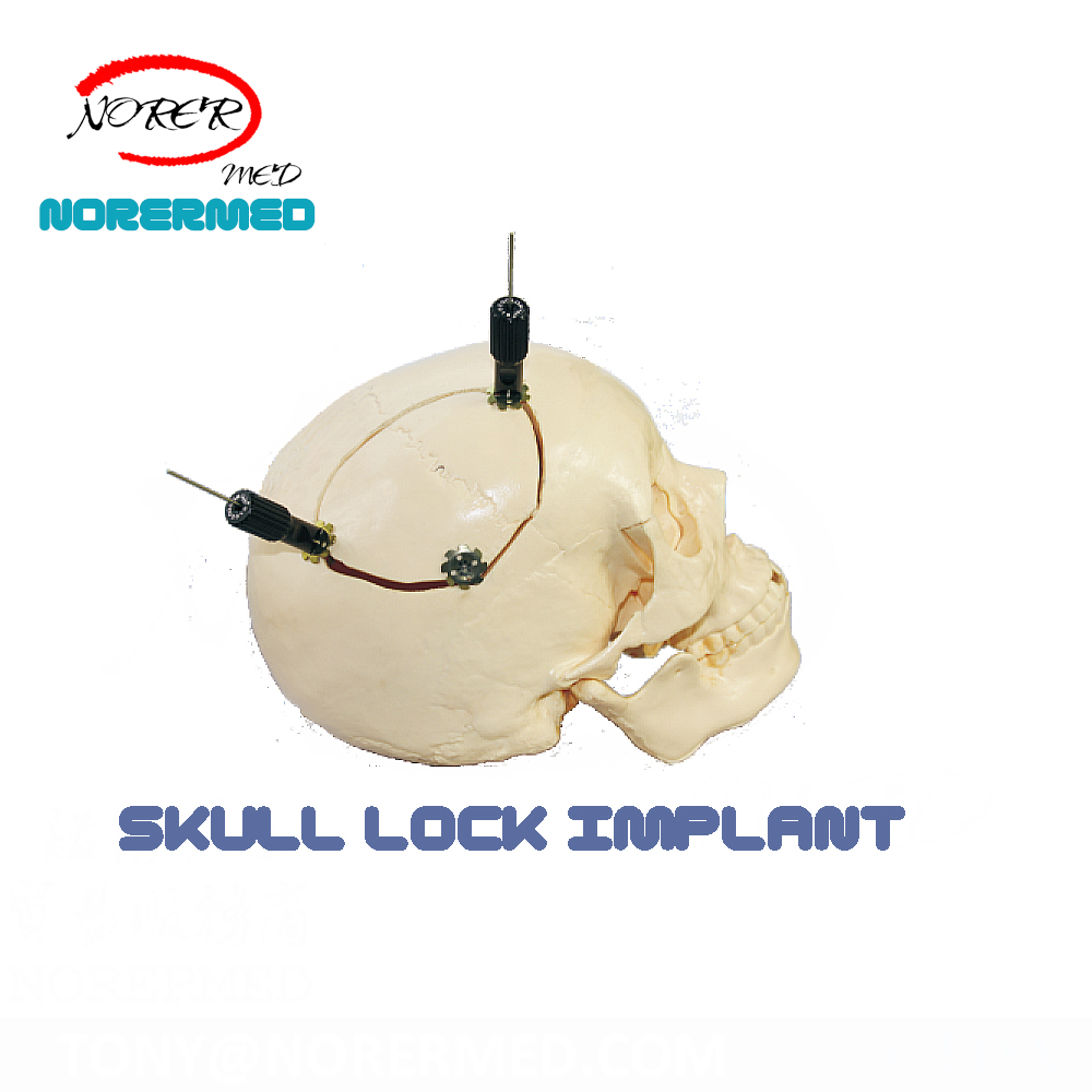 China Manufacturer Titanium Cranial Skull Lock for Skull Implant Surgery
