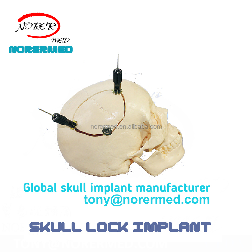 Titanium Skull Lock Implant Side View
