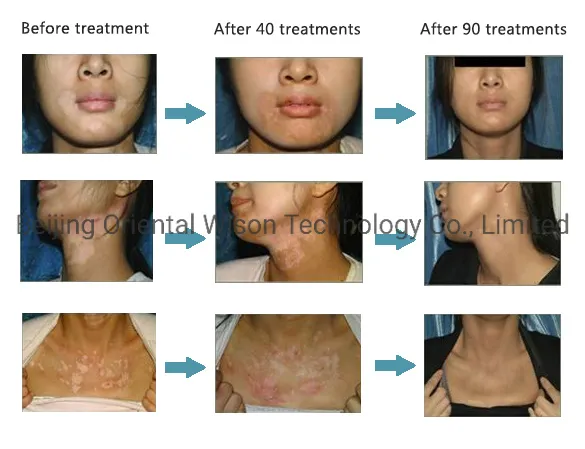 Treatment Function 2