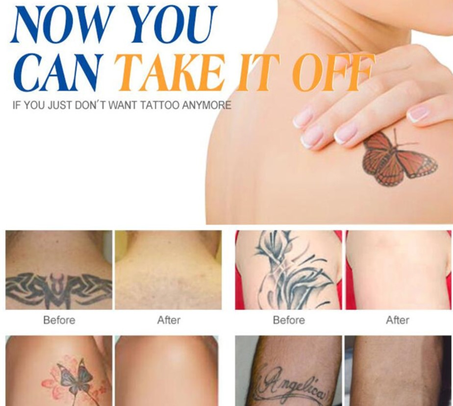 2023 Novo Equipamento de Remoção de Pigmento de Tatuagem e Rejuvenescimento da Pele com Laser ND YAG