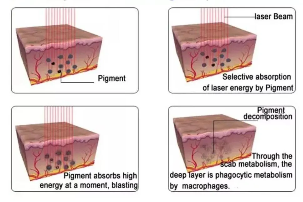 Máquina de Remoção de Tatuagem a Laser ND YAG 1064nm 532nm Ajustável 1-10Hz Remoção de Pigmentação Equipamento de Beleza