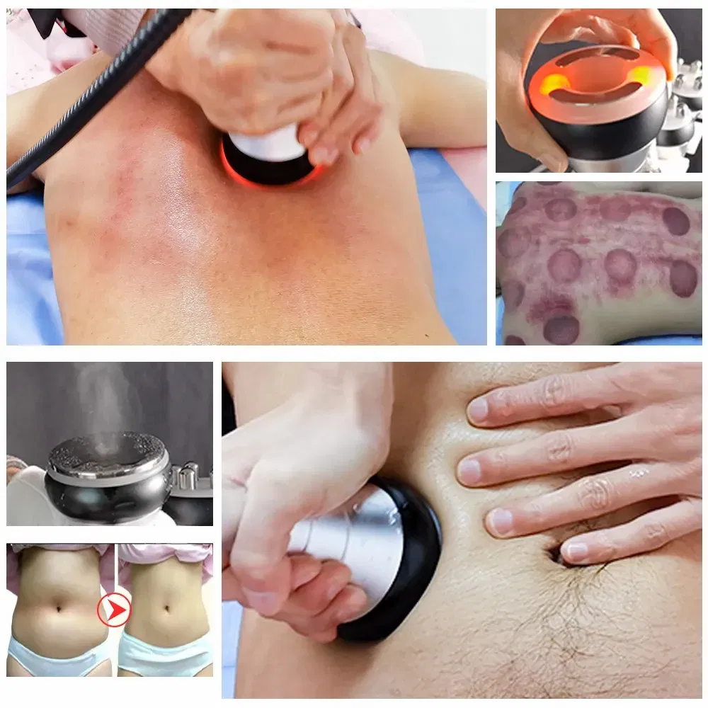 Manípulo RF para Área dos Olhos