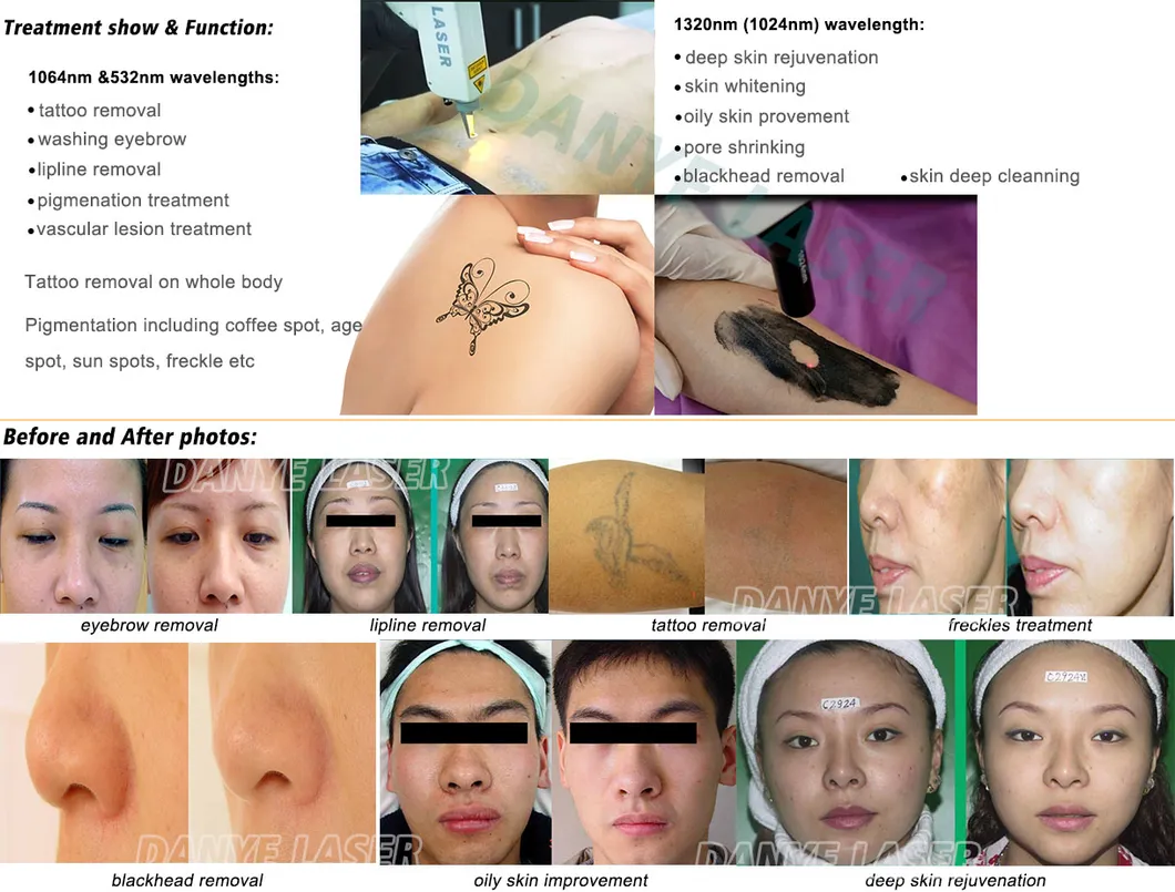 Equipamento de Salão para Remoção de Tatuagem a Laser Q Switch ND YAG