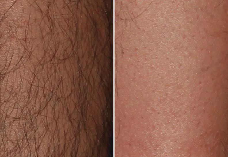 Antes e depois 2