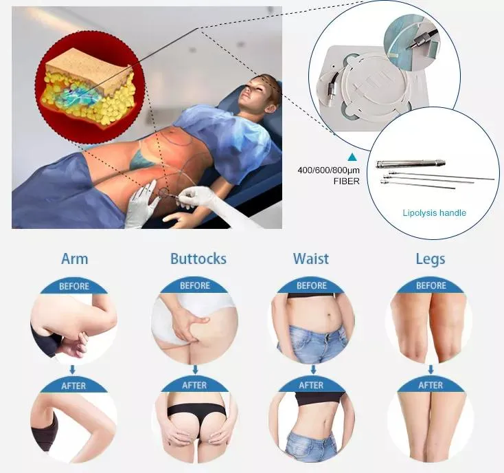 Laser Diodo Endolifting