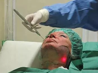 Laser Diodo Endolifting
