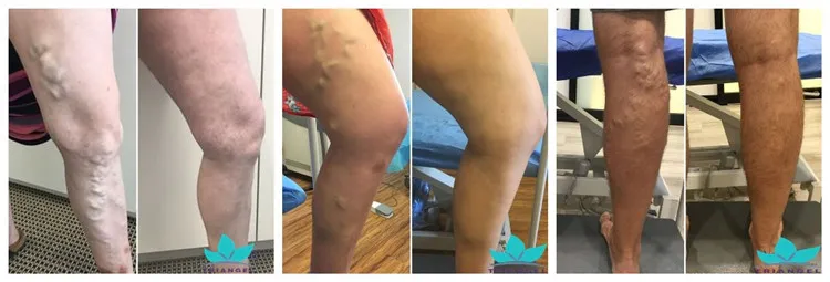 Antes e Depois do Tratamento de Varizes por Laser