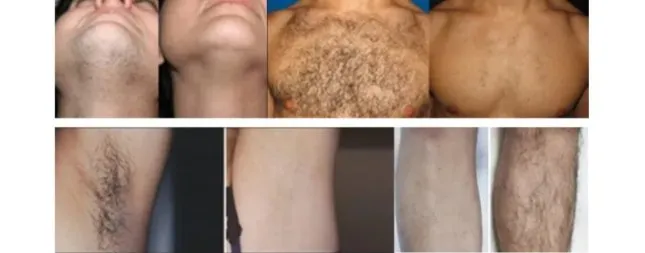 Resultados Antes e Depois da Remoção de Pelos a Laser
