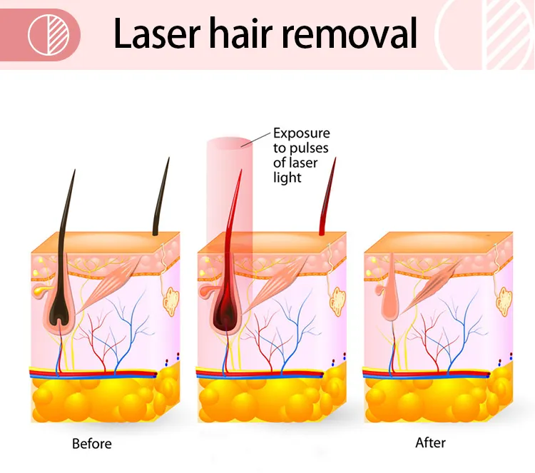 Depilação a Laser Portátil / 808 Preço da Máquina de Depilação a Laser Diodo
