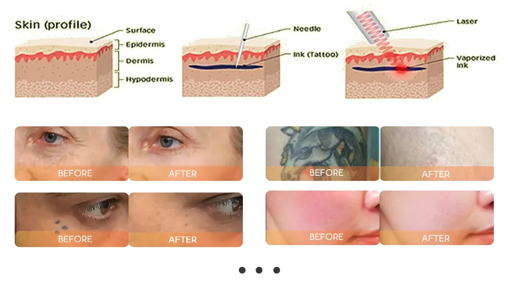 Tratamento Laser Díodo 2