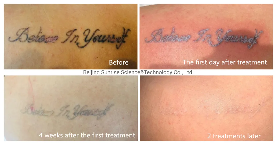 Antes e depois remoção de tatuagem