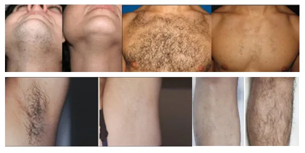 Resultados de Antes e Depois da Depilação a Laser