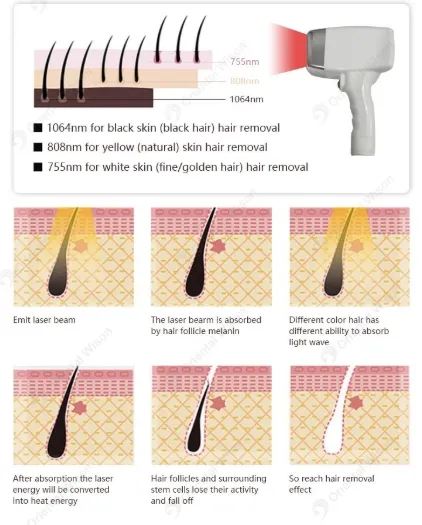 Máquina de Remoção de Cabelo a Laser Diodo Portátil 808nm Dispositivo de Depilação a Laser 3 Onda 808 755 1064 Tripla Comprimento de Onda
