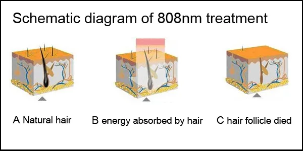 Remoção de Pelo a Laser Diode Avançada 808nm
