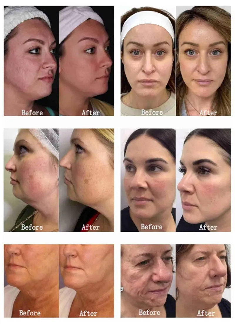 Dispositivo Avançado de Microneedling por Radiofrequência para Renovação de Colágeno e Firmamento da Pele