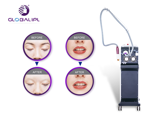Máquina de Remoção de Tatuagem a Laser Q-Switch ND YAG, Peeling de Carbono, Equipamento de Laser para Salão de Cuidados com a Pele