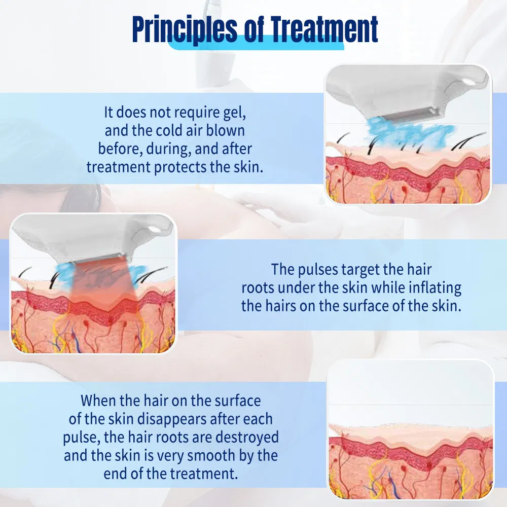 Máquina de Remoção de Pelo CE IPL Elight Dpl Opt Rejuvenescimento da Pele Máquina de Remoção de Rugas com Sistema de Resfriamento