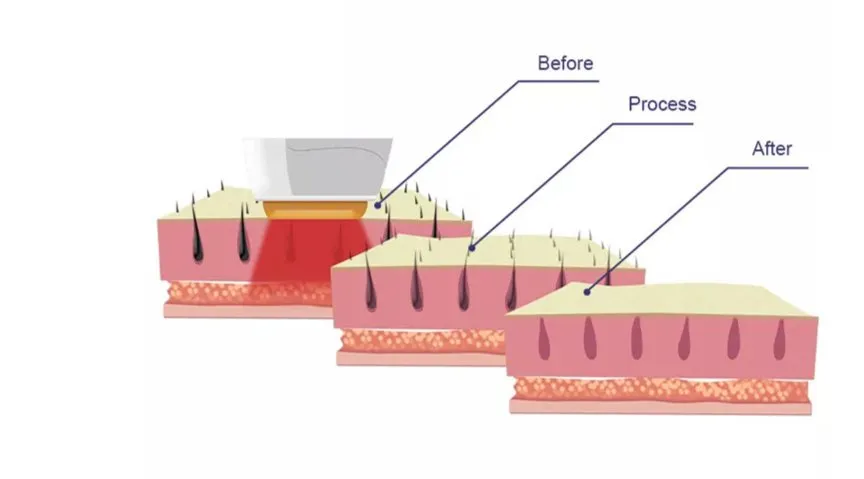 Máquina de Depilação a Laser de Diodo Multi Comprimento Remoção de Cabelo a Laser Remoção de Tatuagem