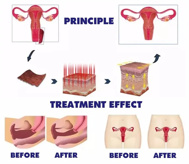 Sonda de Tratamento de Aperto Vaginal