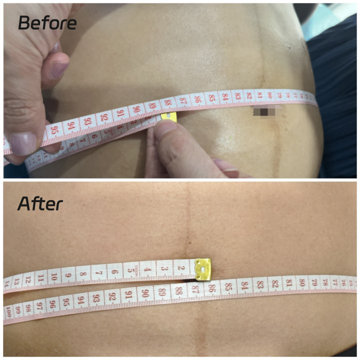 Máquina de Congelamento de Gordura Cryo Slim Máquina de Crioterapia Redução de Medidas Queima de Gordura