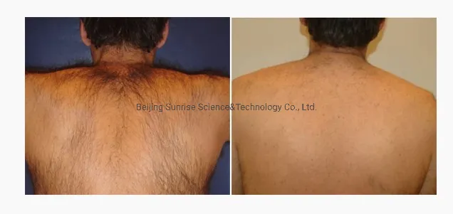 Antes e depois remoção de pelos e tratamentos