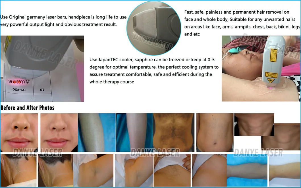 Remoção de Cabelo a Laser de Diodo Depilacin Eficaz para Todos os Tipos de Pele 810nm