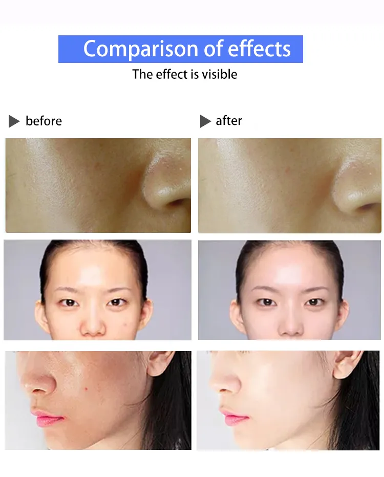 Dispositivo de Beleza com Plasma Frio para Esterilização de Cuidados com a Pele e Cicatrizes de Acne