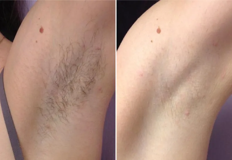 Antes e depois 1