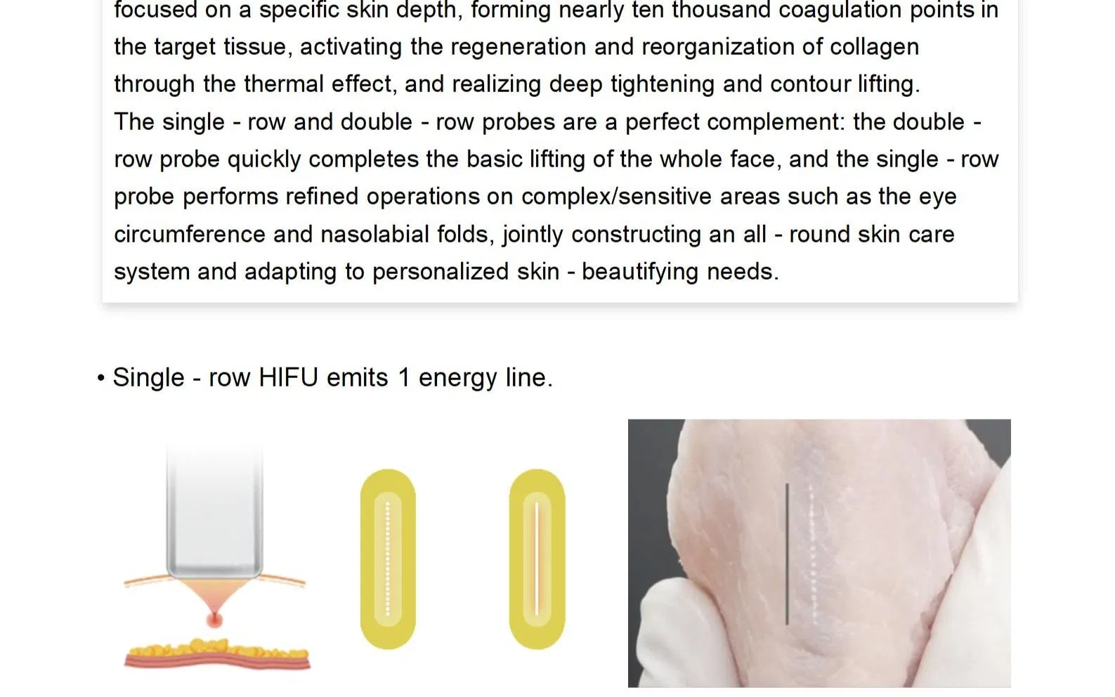 Novo Dispositivo Hefu para Remoção de Rugas, Antienvelhecimento, Modelagem Corporal, Levantamento Facial, Aperto da Pele, Equipamento de Beleza para SPA