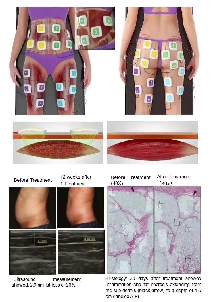 Trusculpt 2 em 1 Perda de Gordura Esculpindo Músculos Firmando Rosto Corpo Emagrecimento Máquina