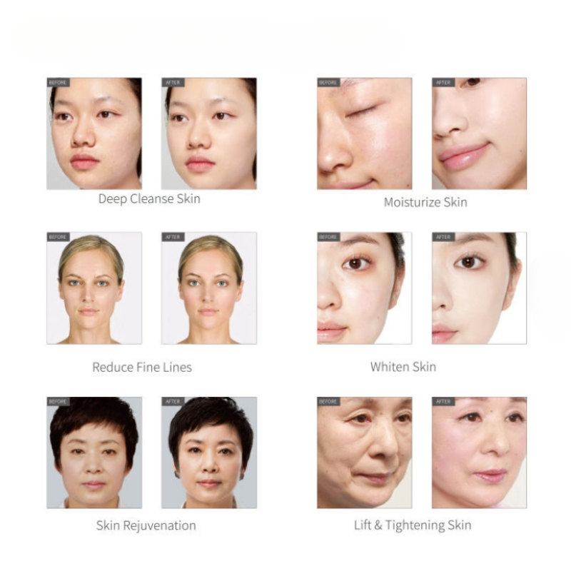 Máquina Profissional de Aqua Peel Limpeza Profunda Dispositivo de Hidro Dermabrasão para Cuidados com a Pele
