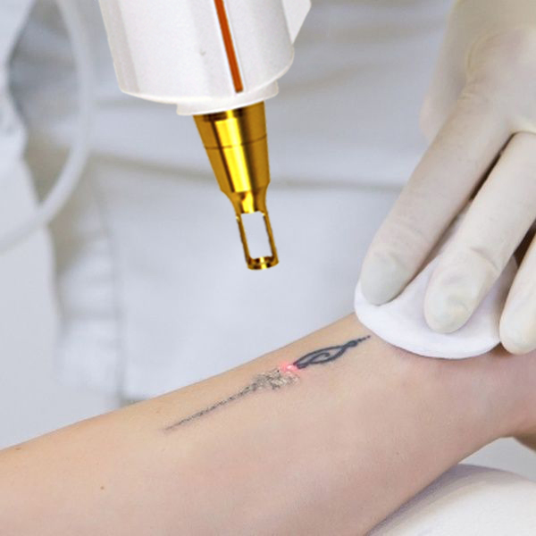 Máquina de Remoção de Tatuagem a Laser ND YAG 1064nm 532nm Ajustável 1-10Hz Remoção de Pigmentação Equipamento de Beleza