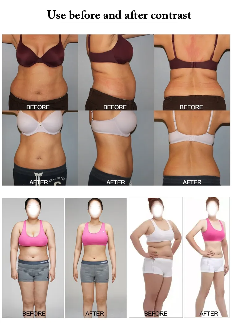 Máquina de emagrecimento corporal com laser lipolaser, criolipólise, laser lipo 336 diodo laser I-Lipo