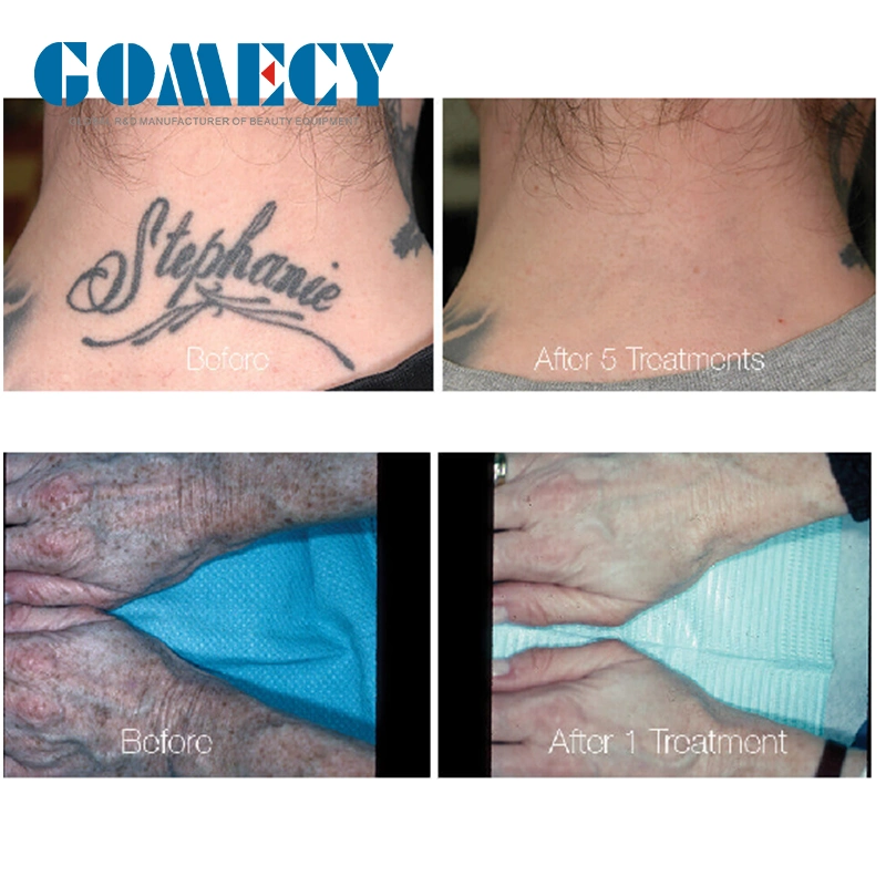 Tattoo Scar Mole Freckle Pico Laser Tattoo Removal