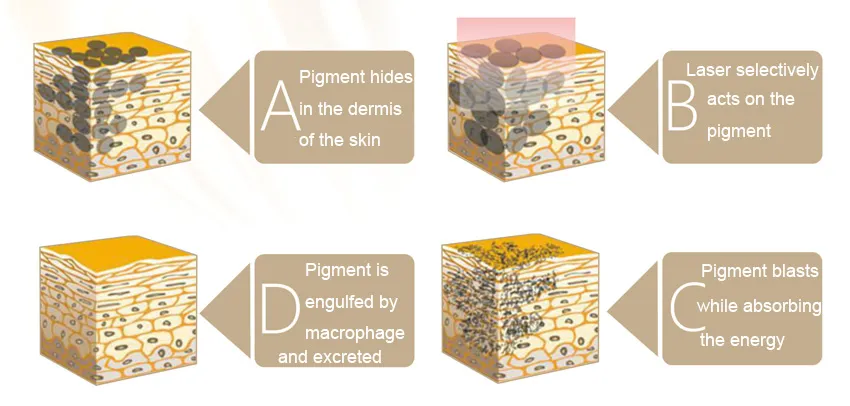 Tattoo Removal Principle