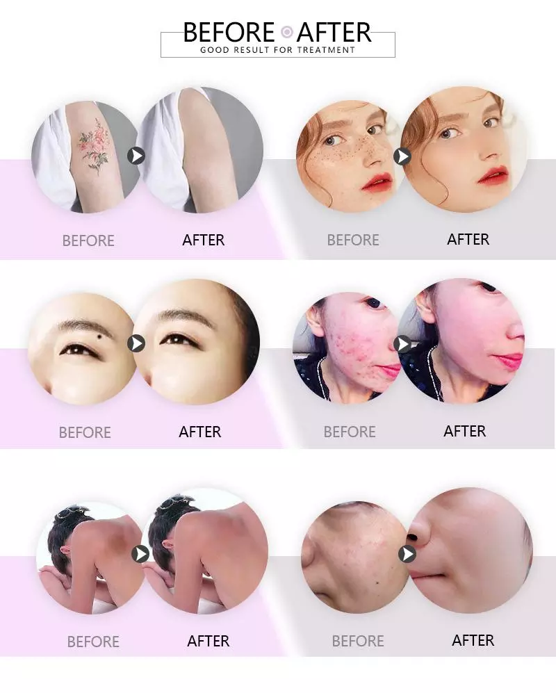Skin Care Beauty Instrument