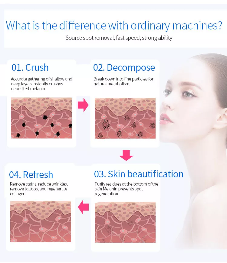 Picosecond Tattoo Removal