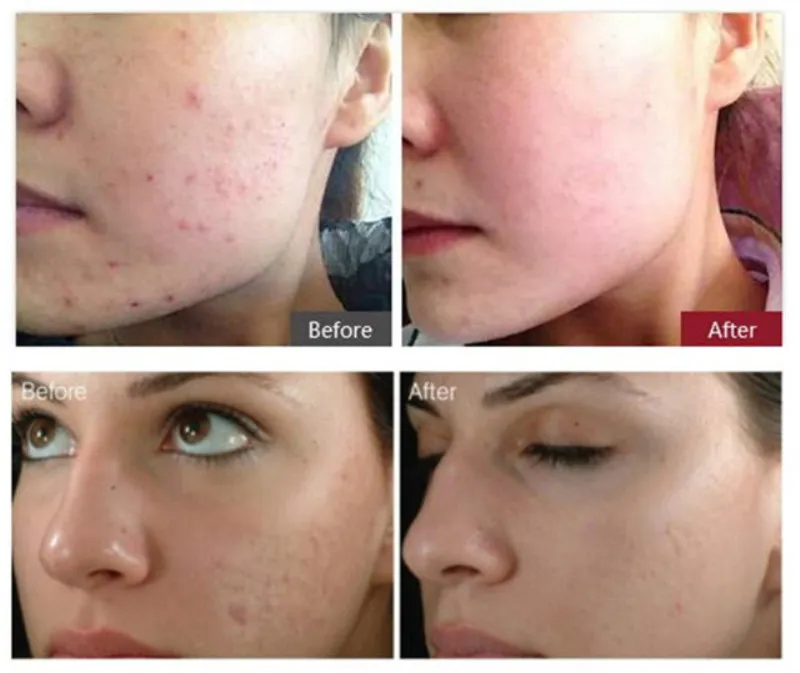 Before and After Results