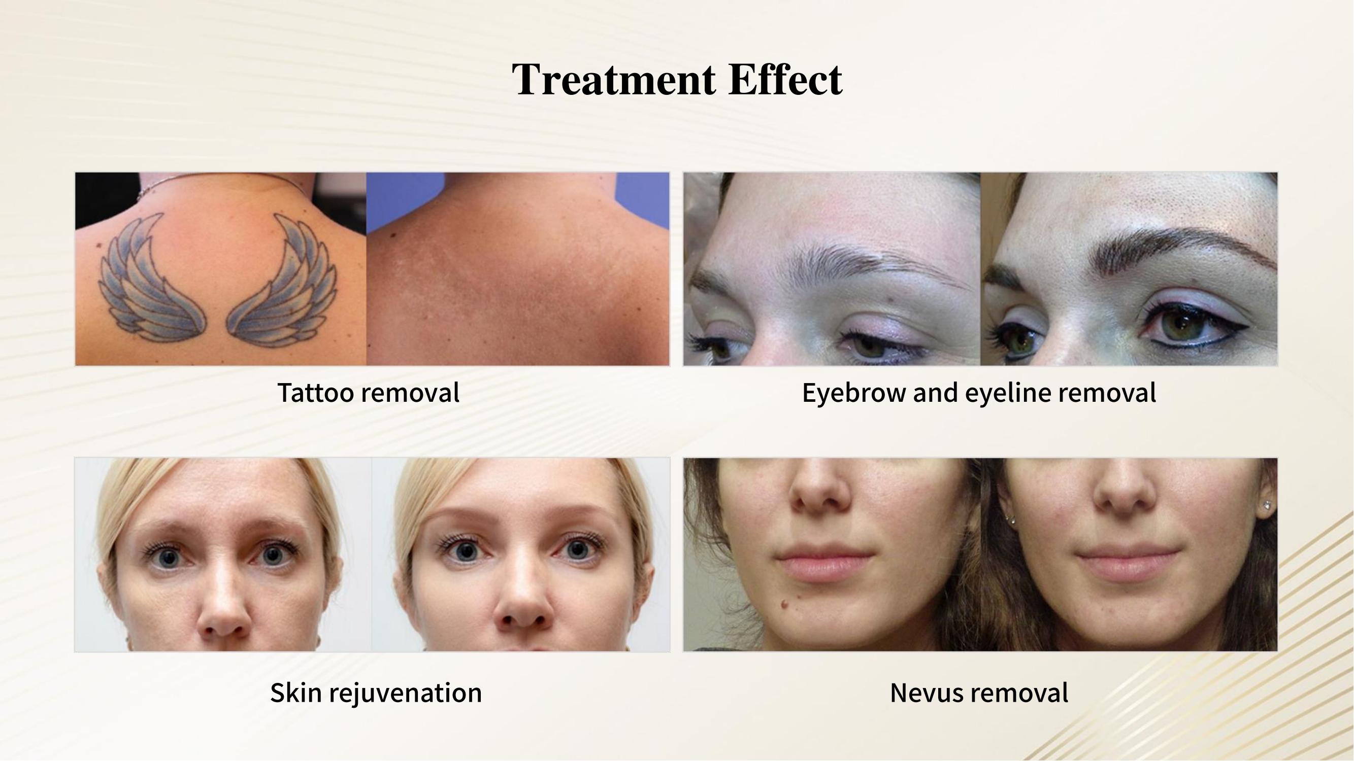 Treatment Effect Before & After