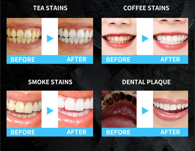 Teeth Whitening Kit 10