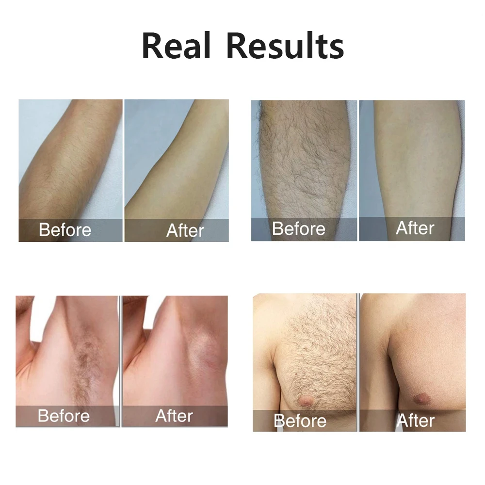 Professional IPL Laser Hair Remover For Women Men 990000 Flashes Painless Permanent Removal For All Body Areas For Household Use