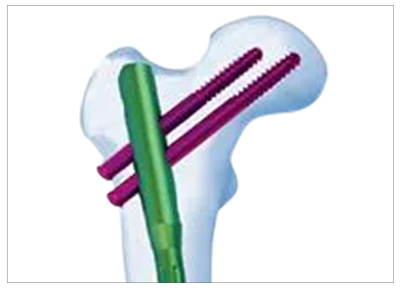 Insertion Angle