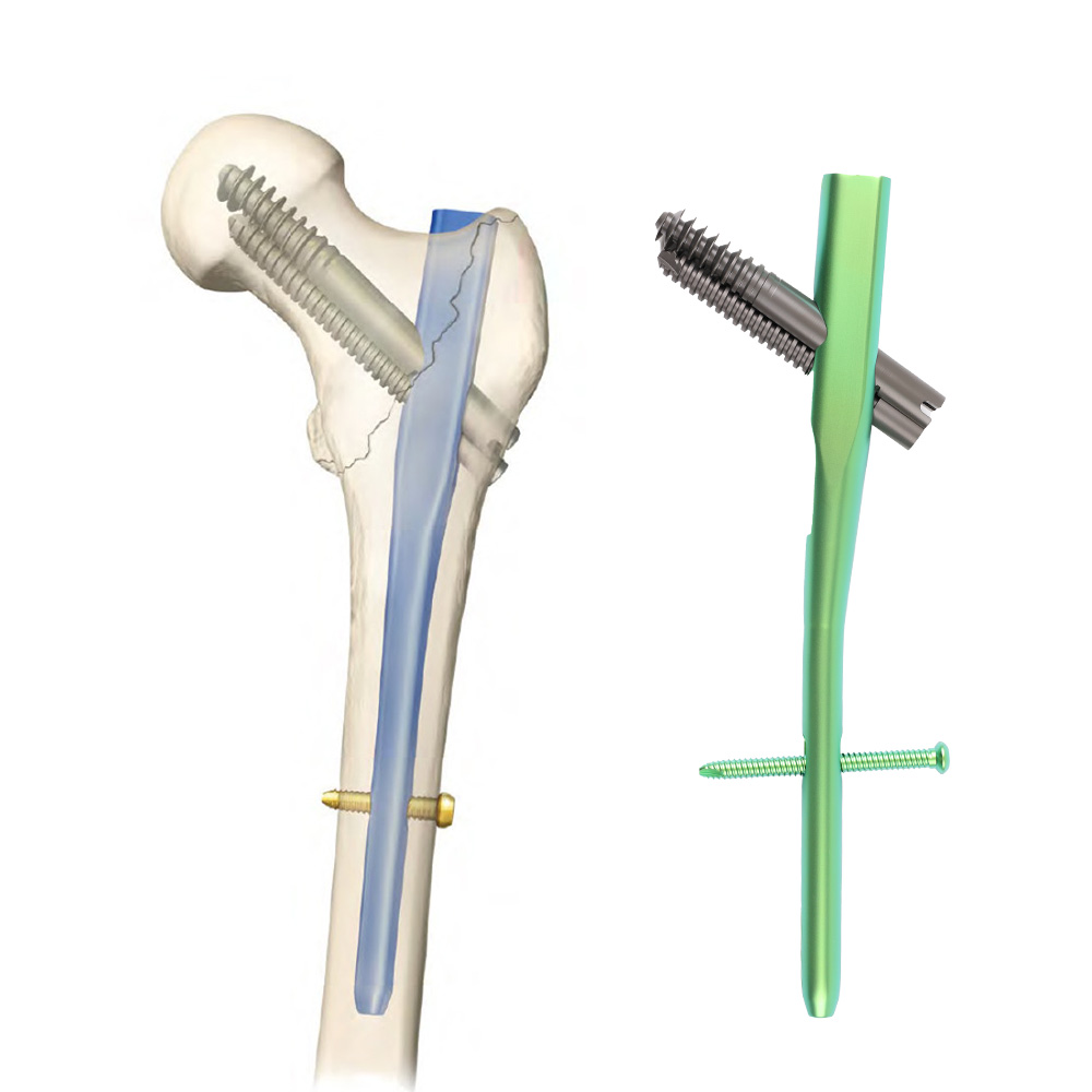 Geasure Intertan Intramedullary Nail Titanium Alloy Orthopedic Implant CE Certified for Proximal Femoral Fracture Treatment