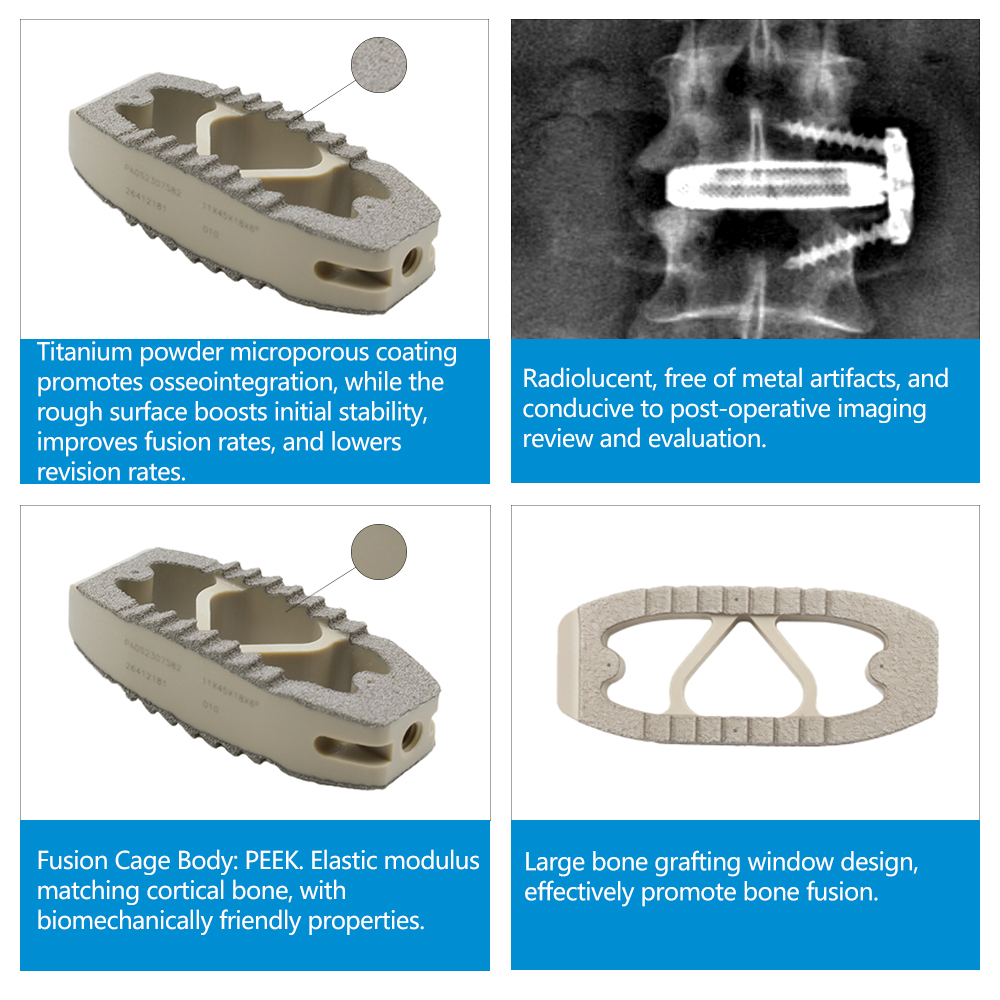 Geasure Orthopedic Implant PEEK+Titanium Coated OLIF Interbody Fusion Cage Posterior Lumbar OEM CE Certified