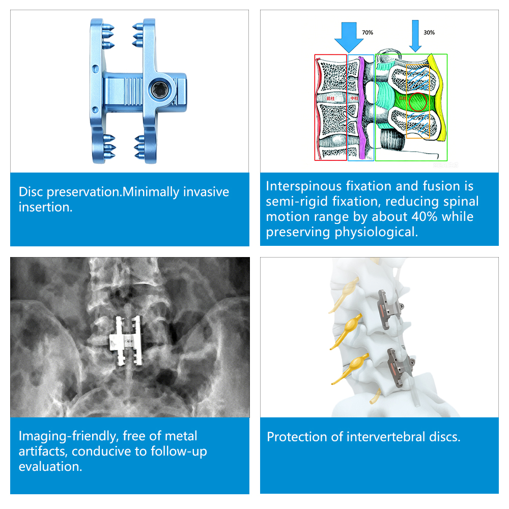 Geasure Orthopedic Implant InterFuse Semi-rigid Titanium Alloy Interspinous Fusion System Size 8-16mm for Degenerative Disc