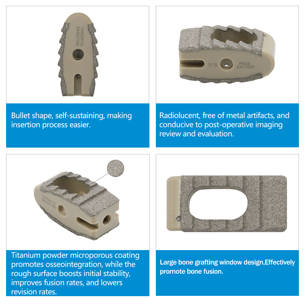 Geasure Orthopedic Spine Implant PEEK Fusion Cage with Titanium Coating for Cervical Intervertebral Fusion Surgery Class III