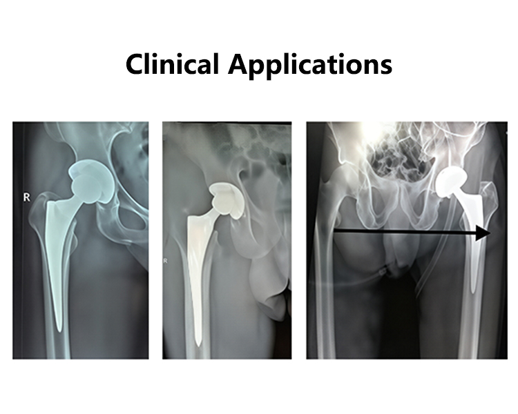 GEASURE Biocompatible Titanium Alloy Cementless Anatomical Hip Stem Plasma Sprayed Coating Orthopedic Surgery Implants Left Hand